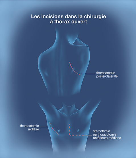 Cancer poumons 4 - Les incisions dans la chirurgie à thorax ouvert