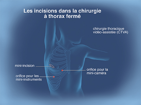 Cancer poumons 5 - Les incisions dans la chirurgie à thorax fermé