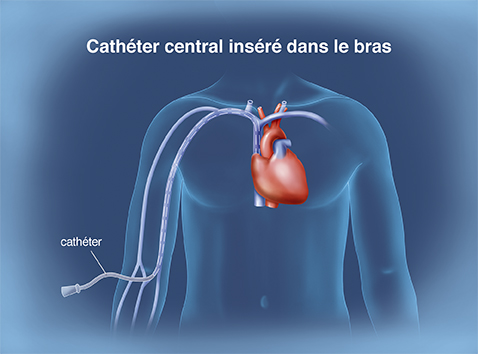 Cancer poumons 8 - Cathéter central inséré dans le bras