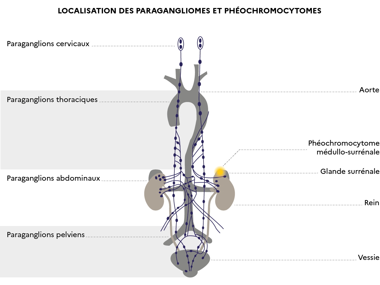 Localisation des phéochromocytomes et paragangliomes malins