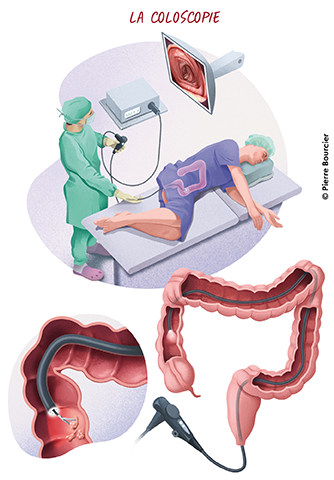 La coloscopie